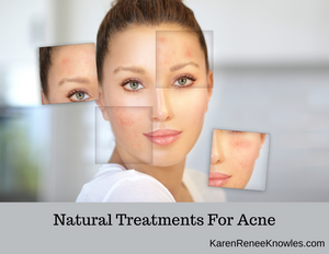 Natural Treatments For Acne